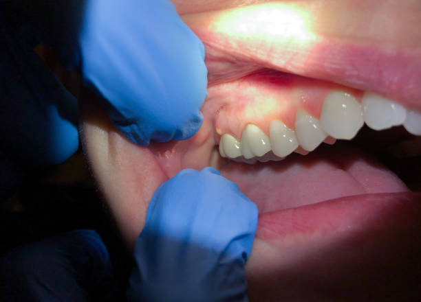 Best Broken or Chipped Tooth Repair in Woodsville, NH